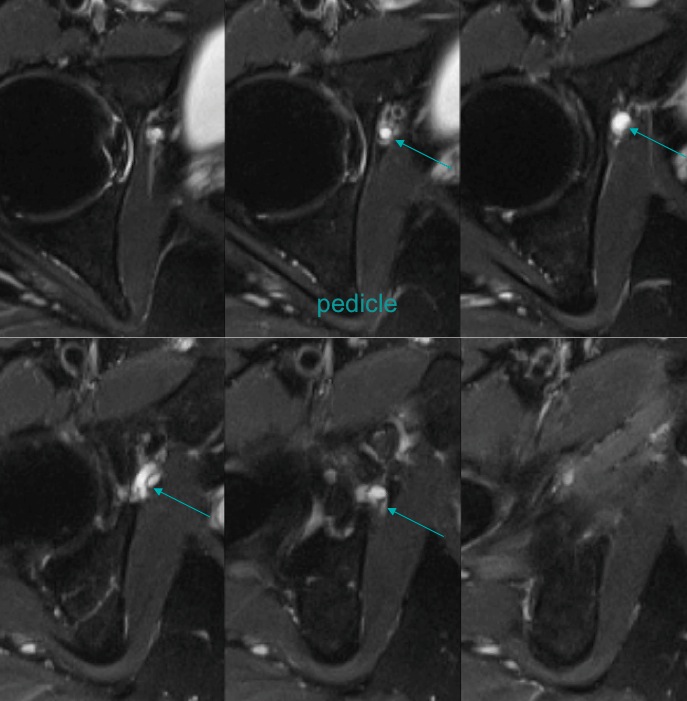Figure 3 for case Obturator nerve impinge by ganglion cyst